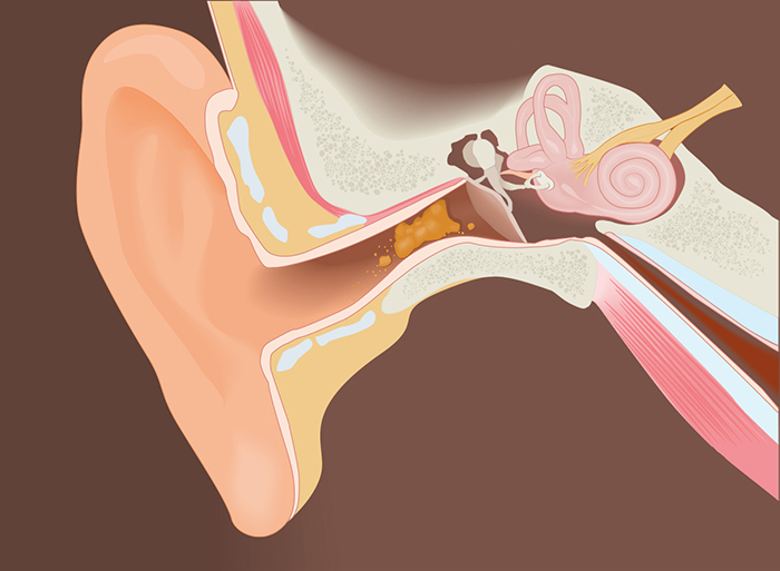 In zicht Rubber dealer Ear Wax Removal | Apex Audiology